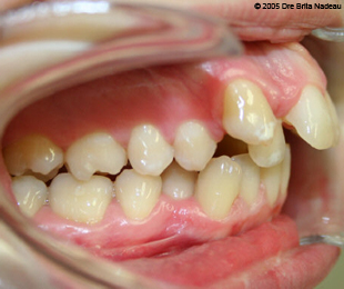 Marie-Hélène Cyr - Right lateral intraoral view - Before orthodontic treatments and orthognathic surgeries (November 24, 2005)